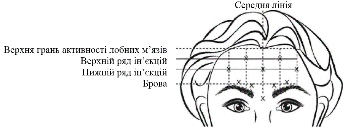 Препарат ботокс® комплекс ботулінічного токсину типу