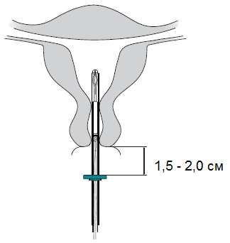 Фото мірена