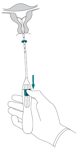 Рецепт мірена