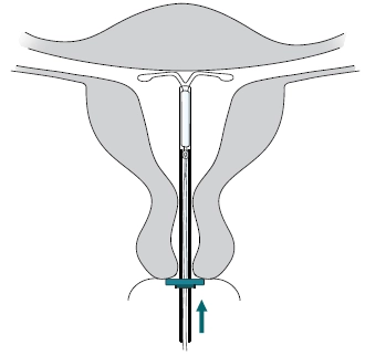 Вплив мірена