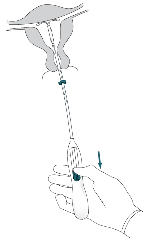 Показання мірена