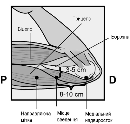 Опис імпланон® нкст