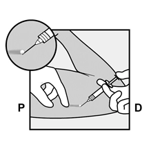 Фото імпланон® нкст