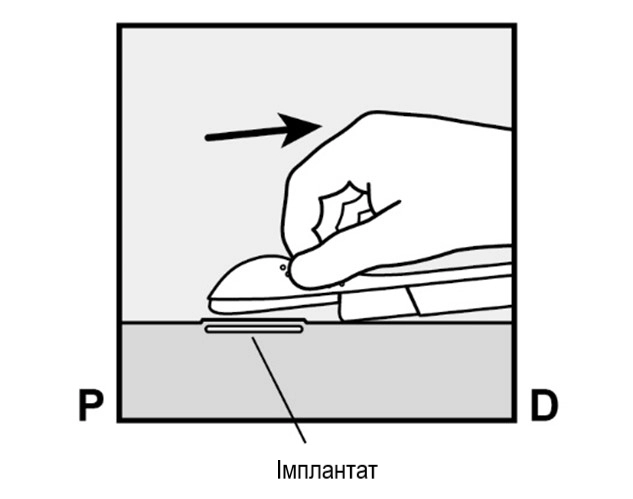 Лікарський засіб імпланон® нкст