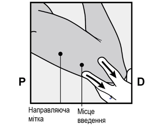 Препарат імпланон® нкст