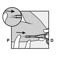 Схема імпланон® нкст