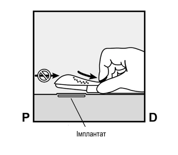Зображення імпланон® нкст
