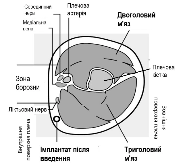 Схема імпланон® нкст