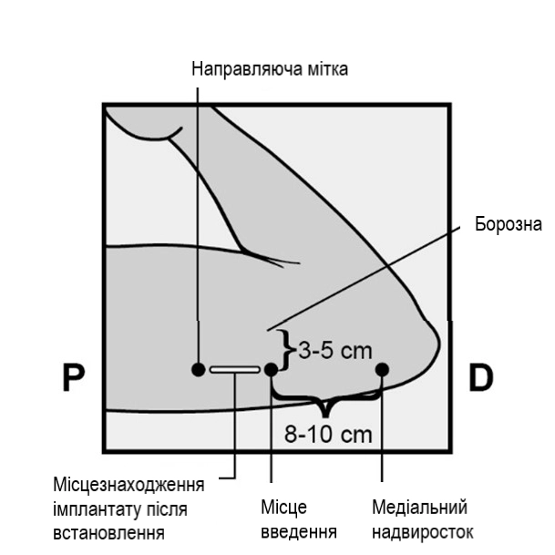 Фото імпланон® нкст
