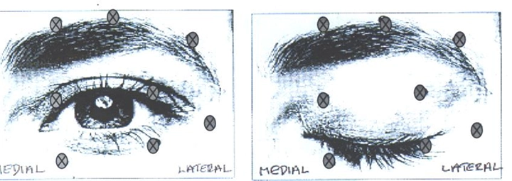 Дія ботокс® комплекс ботулінічного токсину типу