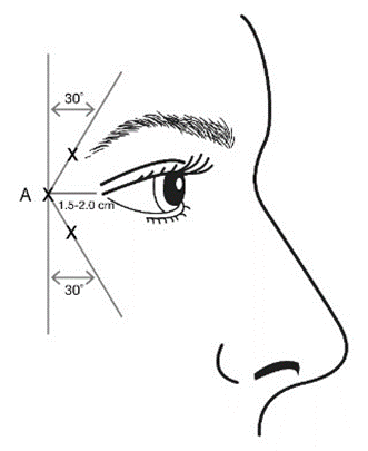 Вплив ботокс® комплекс ботулінічного токсину типу