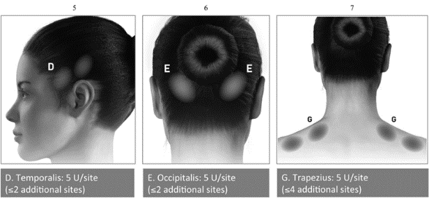 Інструкція ботокс® комплекс ботулінічного токсину типу