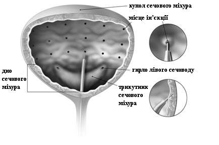 Зображення ботокс® комплекс ботулінічного токсину типу